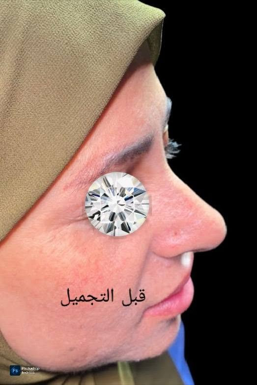 ترميم الأنف • تجميل أنف ثانوي • عيادة الياسيري
