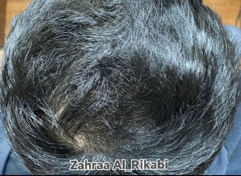 سيروم خصلة • ينبت الفراغات • عشبي ١٠٠٪