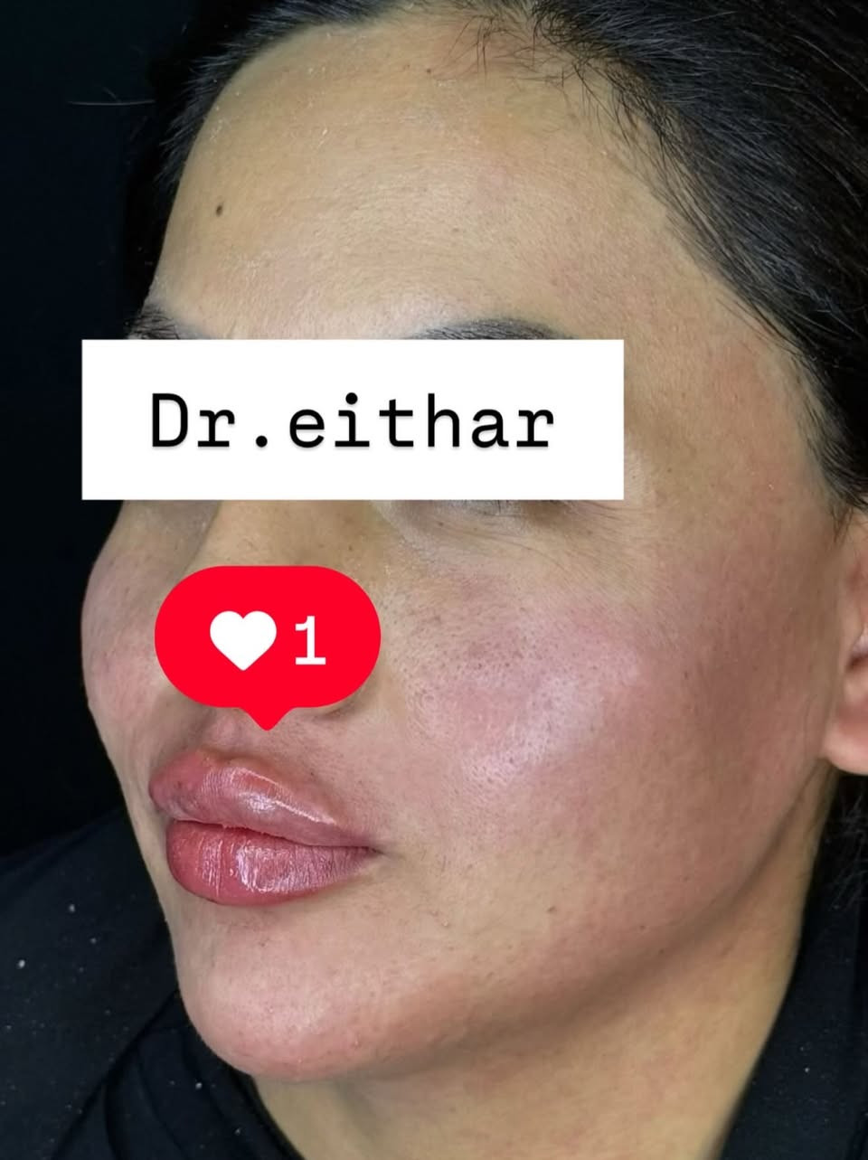 كونتور الوجه بالفلر  (لفتنك وجنات  واصداغ وتدوير الفك والذقن ونظاره وشفة ) 🔥🔥
لاحضو الفرق بالذقن ومنطقه الفك والوجنات شكد تغير الشكل🔥
عروووض للكادر التدريسي والخريجات والموظفات والعروسات  ثبتتهه الكم بالستوري بالهايلايت وببوست اعلى الصفحة ✨✨

د.ايثار سامي عبد الامير
واسط الكوت الهوره مجمع القبطان طابق اول 

الحجز***********
