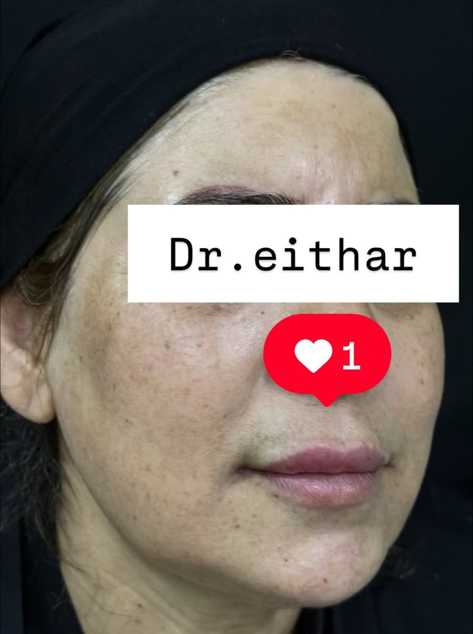 تجديد شد الوجه بالفلر  (لفتنك وجنات  واصداغ وتدوير الفك والذقن ونظاره وشفة سابقا حاقنتهه قبل سنه مجددناه لان متحتاج  ونظاره وبوتوكس  ) 🔥🔥🔥

اتمددت عروووض للكادر التدريسي والخريجات والموظفات والعروسات لنهايه الاسبوع ليوم الاربعاء اخر يوم  ثبتتهه الكم بالستوري بالهايلايت وببوست اعلى الصفحة ✨✨

د.ايثار سامي عبد الامير
واسط الكوت الهوره مجمع القبطان طابق اول 

الحجز***********

نص مكتوب في الصور:
- Dr.eithar
- 1
- Dr.eithar 1