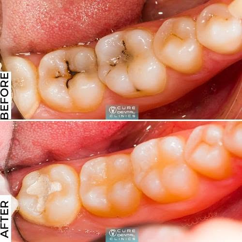 تعلن عيادات جامعة العميد لطب الاسنان عن استقبالها للمراجعين وتوفر حالات علاج الاسنان التالية :
تعلن عيادات جامعة العميد لطب الاسنان عن استقبالها للمراجعين وتوفر حالات علاج الاسنان التالية :
 قلع الاسنان والجذور المتبقية 

حشوة الاسنان التجميلة (البيضاء)

تعويض الأسنان المفقودة بطقم متحرك كامل وجزئي  
  حشوات الأسنان للأطفال 

  تنظيف الاسنان من التكلسات 

العمل  مجاني وتحت إشراف أطباء إختصاص لجميع الحالات  

واتساب ***********
