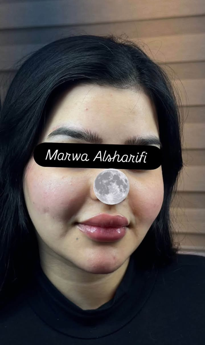 تغيير شامل بالفلر رسمة وجه القمر من ايد خبيرة التجميل الغير جراحي Marwa Alsharifiمروة الشريفي 
للحجز على الرقم ***********
او مراسلة الصفحة
