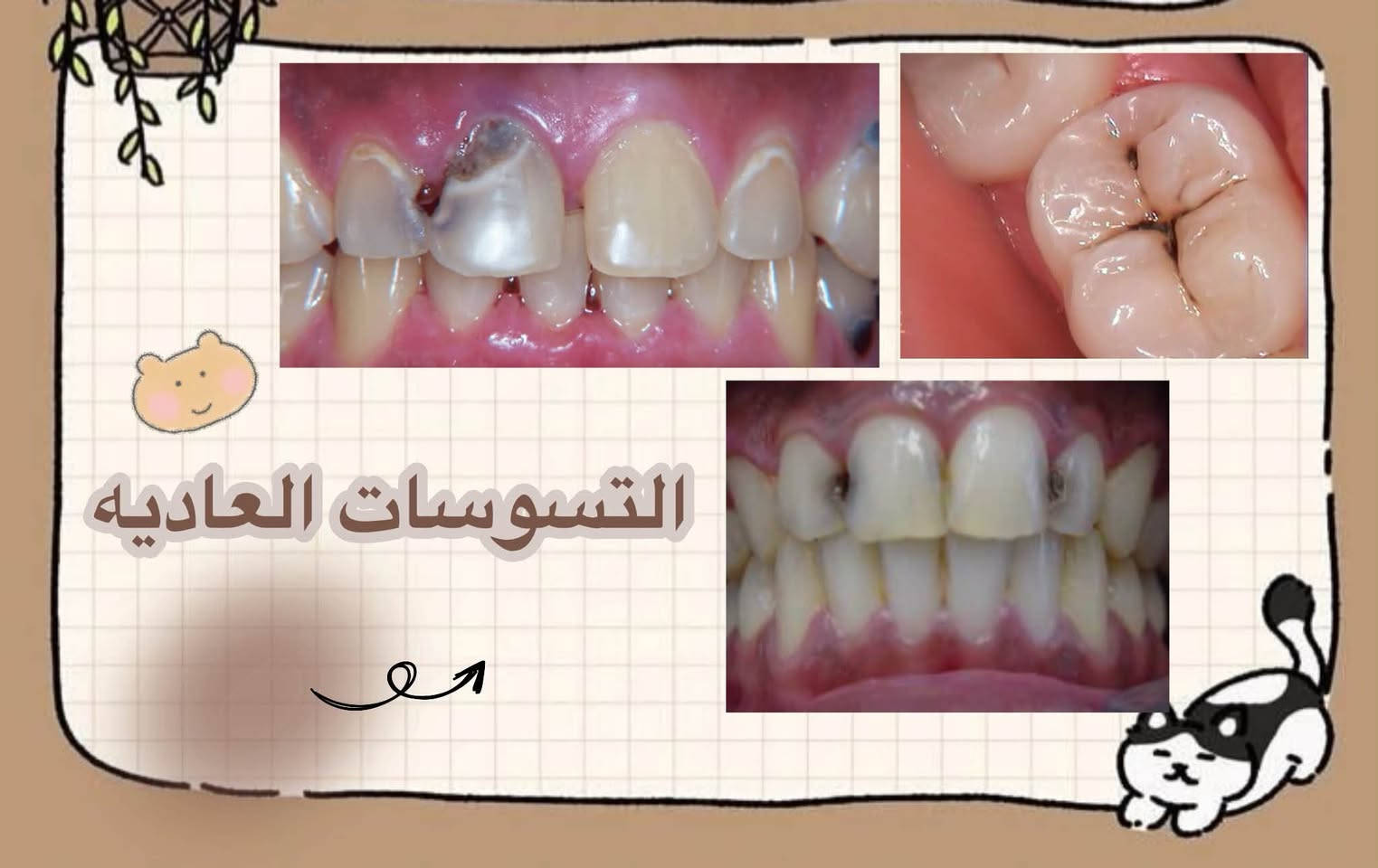 اهتموا بابتسامتكم، والبداية من صحة أسنانكم 🦷✨
تتوفر خدمات علاجية متنوعة ضمن العيادات
الجامعية، منها:
حشوات الأسنان
اقلع الجذور
ا تنظيف التكلسات ا
أطقم الأسنان
(العلاج يتم داخل العيادات الجامعية وتحت إشراف)
الكادر المختص.
للتفاصيل والاستفسار، التواصل عبر الرقم / واتساب
+964 789 158 6853
***********

نص مكتوب في الصور:
- الحالات اللي نستقبله
- التسوسات العاديه
- السن انكسر وضل عندك جذر متبقي
- قبل بعد في حال انكم فاقدين اسنان وتريدون تعوضوهن بطقم جزئي مثل هالحاله
- و تنظيف التصبغات اكيد