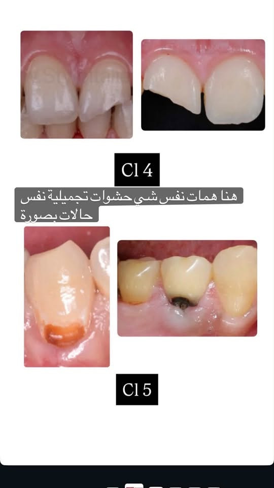 السلام عليكم علاج مجاني بالكامل
وبأفضل الأدوات تتم المعالجة وتحت إشراف أطباء أختصاص   للحالات الاتية :

الي عنده حشوات امامية وخلفية  تجميلية أسويهم 

وقلع اسنان وبقايا جذور

تنظيف اسنان وازالة التكلسات 

طقم جزئي متحرك 

العنوان ب يرموك كلية الحكمة 

تفاصيل اكثر ع هذا رقم واتساب

***********

