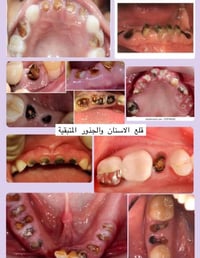علاج مجاني • قلع اسنان • حشوة تجميلية