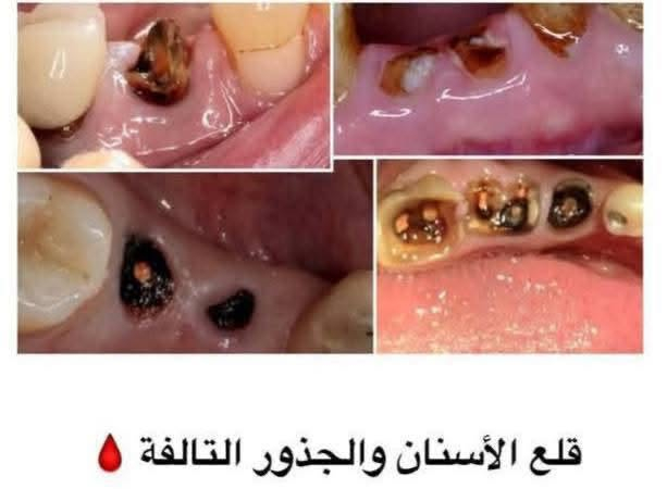 فحص علاج مجاني • تنظيف حشوات قلع • طريق حلة-نجف