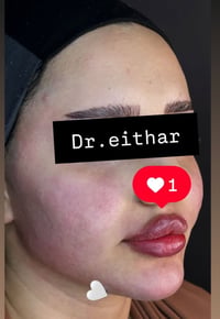كونتور بالفلر • تدوير الفك والذقن • الكوت الهوره