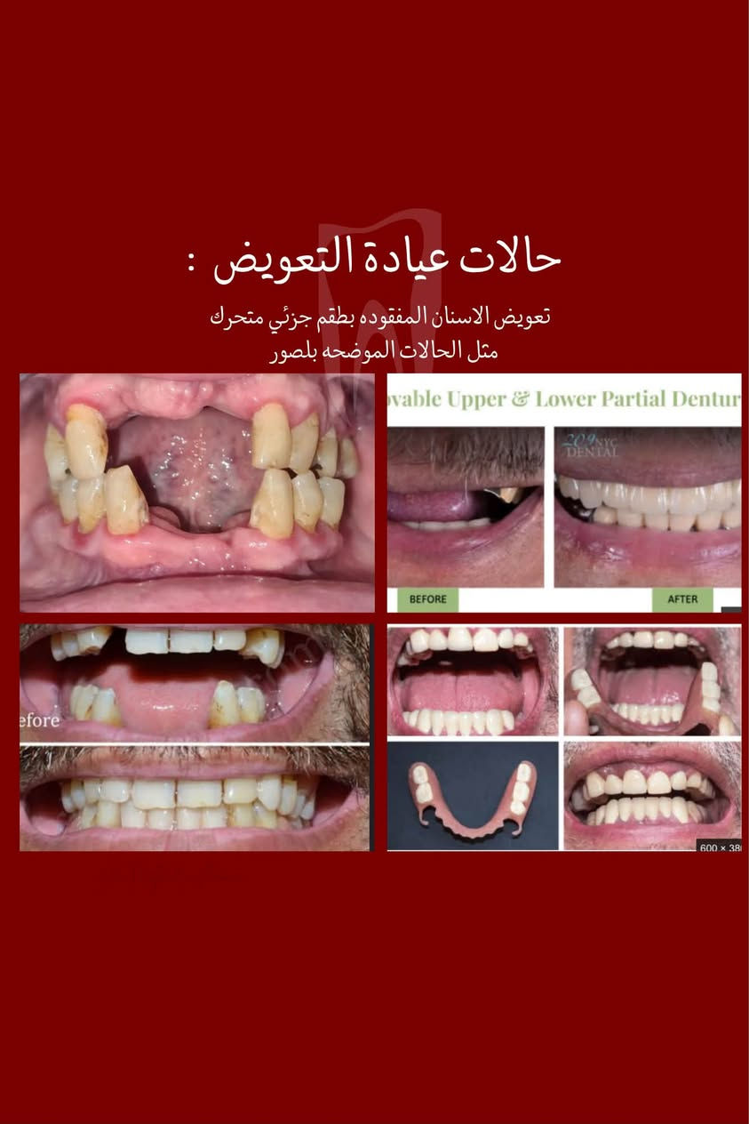 السلام عليكم
نعلن عن توفر خدمات العلاج المجاني للأسنان بشكل كامل 
تحت اشراف اطباء مختصيين 
بحالة عدكم 
(قلع ، تسوسات ، تعويض اسنان بطقم متحرك، تنظيف اسنان) والحالات الي موجوده بلصور وتحبون تعالجوها   بشكل مجاني تكدرون تتواصلون ويايه ونرتب موعد يناسبكم على الرقم  ***********  
موقع العيادات : الدوره _ شارع المصافي_ كلية دجله الجامعه

نص مكتوب في الصور:
- الدكتورة رغد عامر طالبة طب اسنان تحت التدريب من خدماتنا علاج تسوس الاسنان باستخدام الحشوات الضوئيه تعويضات صناعية للأسنان المفقوده تنظيف الاسنان وتلميع الاسنان من التكلسات قلع الاسنان وبقايا الجذورالتالفه احجز موعدك الأن الدورة_ شارع المصافي_ جامعة دجله *********** @msqai علماً ان العلاج مجاني و تحت اشراف اطباء مختصییبن
- حالات عيادة الجراحة : بقايا جذور الاسنان التالفه الاسنان المتحركه الاسنان التالفه
- حالات عيادة الحشوات :
- • تسوس على سطح السن
- • بين الاسنان الخلفيه
- • بين الاسنان الامامية
- • حافات الاسنان المكسوره
- • تسوس قريب اللته
- • ازالة الحشوات القديمة
- حالات عيادة التنظيف : التكلسات التصبغات بسبب التدخين والمشروبات اي احد يحب يسوي تنظيف يكدر يتواصل ويايه ( اللي موضح بلصوره كذلك )
- حالات عيادة التعويض : تعويض الاسنان المفقوده بطقم جزئي متحرك مثل الحالات الموضحه بلصور