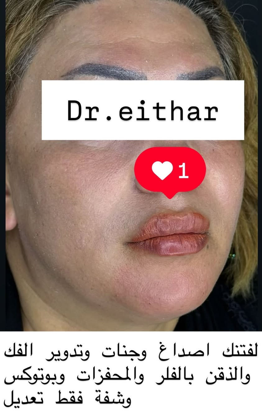 شد الوجه بالفلر والمحفزات  (لفتنك وجنات  واصداغ وتدوير الفك والذقن ونظاره وشفة فقط تعديل لان عدهه اختلاف بين الجهتين وبوتوكس  بعد اسبوعين من الحقن ) 🔥🔥🔥

اتمددت عروووض للكادر التدريسي والخريجات والموظفات والعروسات لنهايه الاسبوع ليوم الاربعاء اخر يوم  ثبتتهه الكم بالستوري بالهايلايت وببوست اعلى الصفحة ✨✨

د.ايثار سامي عبد الامير
واسط الكوت الهوره مجمع القبطان طابق اول 

الحجز***********

نص مكتوب في الصور:
- Dr.eithar 1 شد الوجه بالفلر والمحفزات(اصداغ ووجنات وتدوير الفك والذقن) وبوتوكس وشرفة فقط تعديل لان عده جهه بيه تليف نتيجة ضربة قديمه وعاليه
- Dr.eithar
- 1
- هنا النتيجة بعد اسبوعين بس
- شوفو التجاعيد بالكصه شون
- راحت وحول العين وانفتحت العين
- والحاجب انرفع
- Dr.eithar 1 لفتنك اصداغ وجنات وتدوير الفك والذقن بالفلر والمحفزات وبوتوكس وشفة فقط تعديل
- قبل الحقن نزول بالووجنات ومنطقة الفك صغيره وبيهاه نزول وترهل بحيث ماكو فصل بينه وبين اللغلوغ
- قبل الحقن