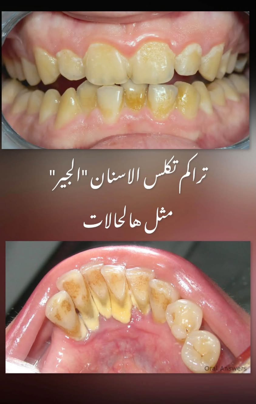 السلام عليكم نستقبلكم لعلاج الحالات الاتية علماً ان العلاج يتم بشكل مجاني تحت اشراف افضل الاطباء وذوي خبرة على مستوى المحافظة اي شخص عنده سن حاب يقلعه او جذور او يريد يسوي حشوة او تنضيف يتواصل مع الرقم ويتدلل العنوان واسط جامعة الكوت (الي صايرة على طريقة الحي) والي يحب يشوف الشغل يدخل على الصفحه علمود يشوف الحالات الي اشتغلنا باعلى كفاءة ولله الحمد

***********

نص مكتوب في الصور:
- اسنان تالفة وجذور متبقية
- الصنف الرابع من التسوس يكون في حواف الاسنان الامامية "تسوس او كسر" الصنف الخامس من التسوس يكون في المنطقة القريبة من اللثة في الاسنان الامامية والخلفية
- تراكم تكلس الاسنان "الجير" مثل هالحالات
