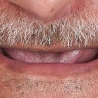 تعويض اسنان • واتساب