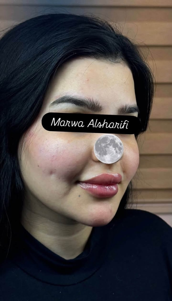 تغيير شامل بالفلر رسمة وجه القمر من ايد خبيرة التجميل الغير جراحي Marwa Alsharifiمروة الشريفي 
للحجز على الرقم ***********
او مراسلة الصفحة
