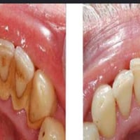تنضيف اسنان مجاني • عيادات اوروك الكرادة • حجز محدود