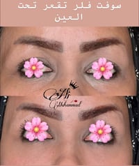 سوفت فلر • تقعر تحت العين • العزيزية