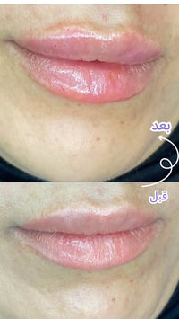 فلر شفاه • بسماية • تقسيط بدون مقدم