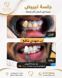 تبييض اسنان • جلسة وحدة • عيادة هايجنك