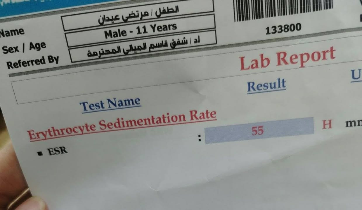 طفل عمره 11 سنة، استمرت عنده الحمى أكثر من 12 يوم، وياها تشقق بالشفايف، تقشر بالأطراف، طفح جلدي وتضخم بعقدة لمفاوية بالرقبة.
بالفحوصات: CRP: 187 | ESR: 55  ____ 771/ Platelets 
وبعد الفحص السريري وإجراء إيكو للقلب، صار عدنا اشتباه قوي بمرض كاواساكي.
تم البدء بالعلاج المناسب والمتابعة الدقيقة، والحمد لله كانت الاستجابة ممتازة؛
#عيادة #الدكتورة #شفق #قاسم #مجيد #الميالي 
اختصاص البورد العراقي في طب الأطفال وحديثي الولاده
الحمزة الشرقي شارع الأطباء مجمع اوزون الطبي O3 
 رقم الحجز ***********

