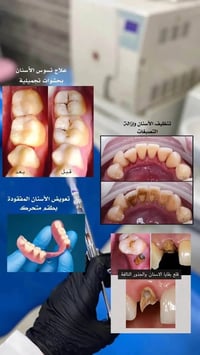 علاج مجاني • عيادات جامعة الهادي • حشوات تجميلية