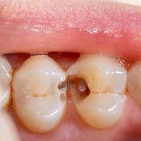 تنظيف اسنان • حشوات ضوئية • مجانا