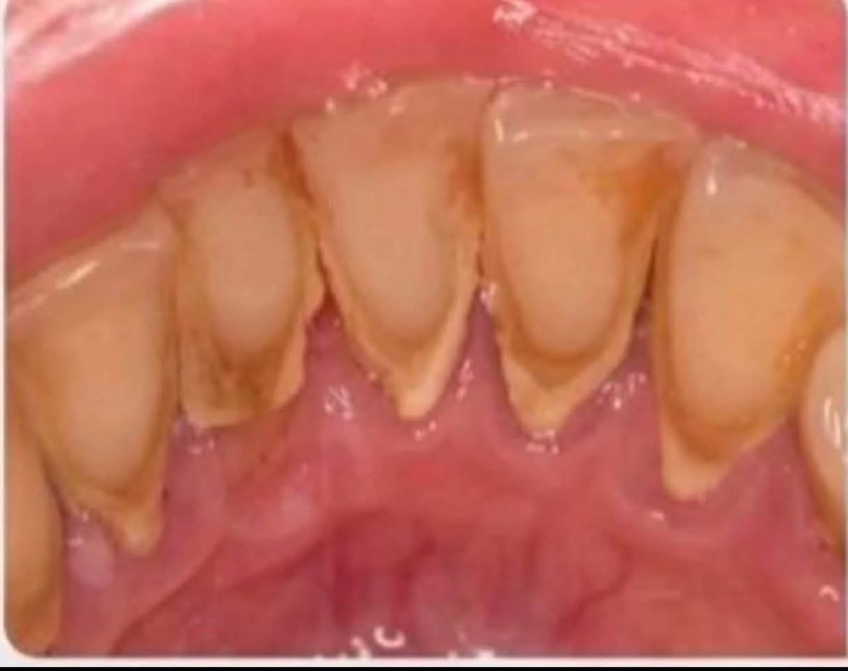 متوفر عدنا علاج الاسنان مجاناً بالكامل
تحت إشراف أطباء مختصين
خدمتنا:
حشوات للاسنان 
قلع الاسنان او الجذور المتبقية
تنظيف الاسنان 
موقعنا: كربلاء _ خلف مول الحارث_ سيطرت السعديه
للتواصل عبر الوتساب او الاتصال على الرقم
***********

نص مكتوب في الصور:
- معاً نحو ابتسامة أجمل مجاناً 1 قلع الأسنان والجذور المتبقية 2 حشوات ضوئية 3 تنظيف الأسنان 4 تعويض الأسنان بطقم متحرك الدكتور: مصطفى حيدر كربلاء - السعدية خلف مول الحارث ( عيادات بيارق العميد التعليمية ) *********** صحتك .. ابتسامتك
- BEFORE AFTER