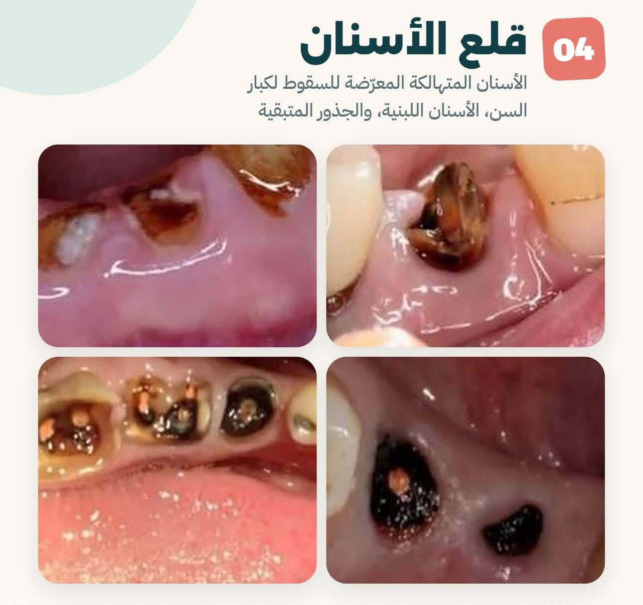 الكرادة جامعة اوروك • علاج مجاني • تنظيف الأسنان