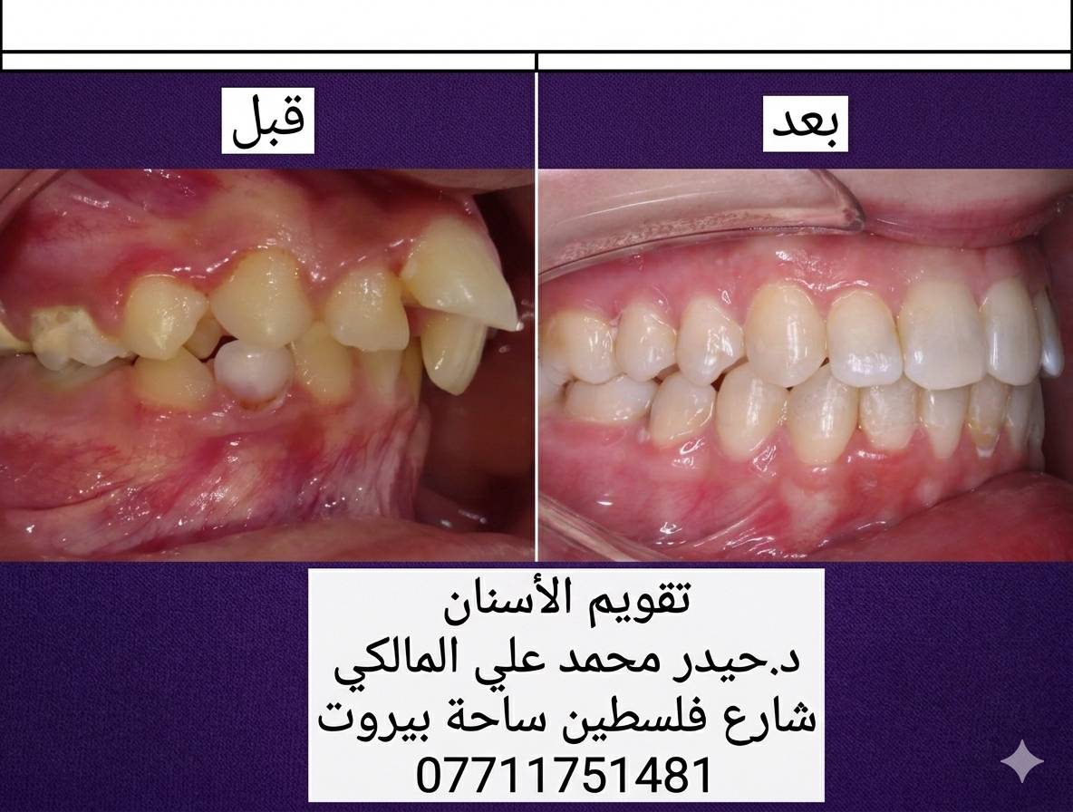 تقويم أسنان • بالتقسيط • شارع فلسطين