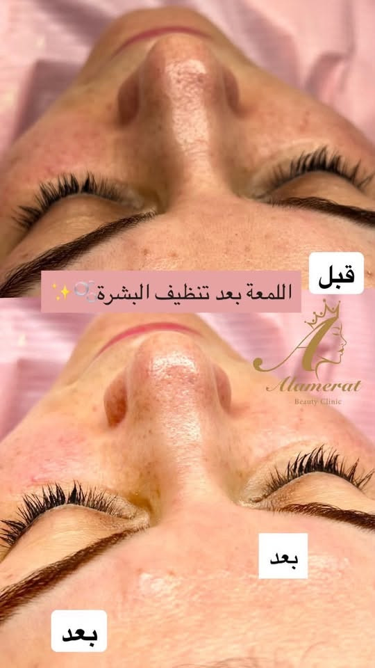 ✨ الدكتورة غيداء عبد الواحد الآن في عيادة الأميرات
نستقبلكم في موقعنا الجديد داخل مجمع زيونة الطبي لتقديم خدمات الجلدية والحساسية والليزر والعناية بالبشرة بكل اهتمام 🤍

📍 تكريت – شارع زيونة – مجمع زيونة الطبي
عيادة الأميرات
📞 للحجز والاستفسار: ***********

ننتظركم بكل حب ✨

نص مكتوب في الصور:
- قبل اللمعة بعد تنظيف البشرة بعد بعد Alamerat Beauty Clinic