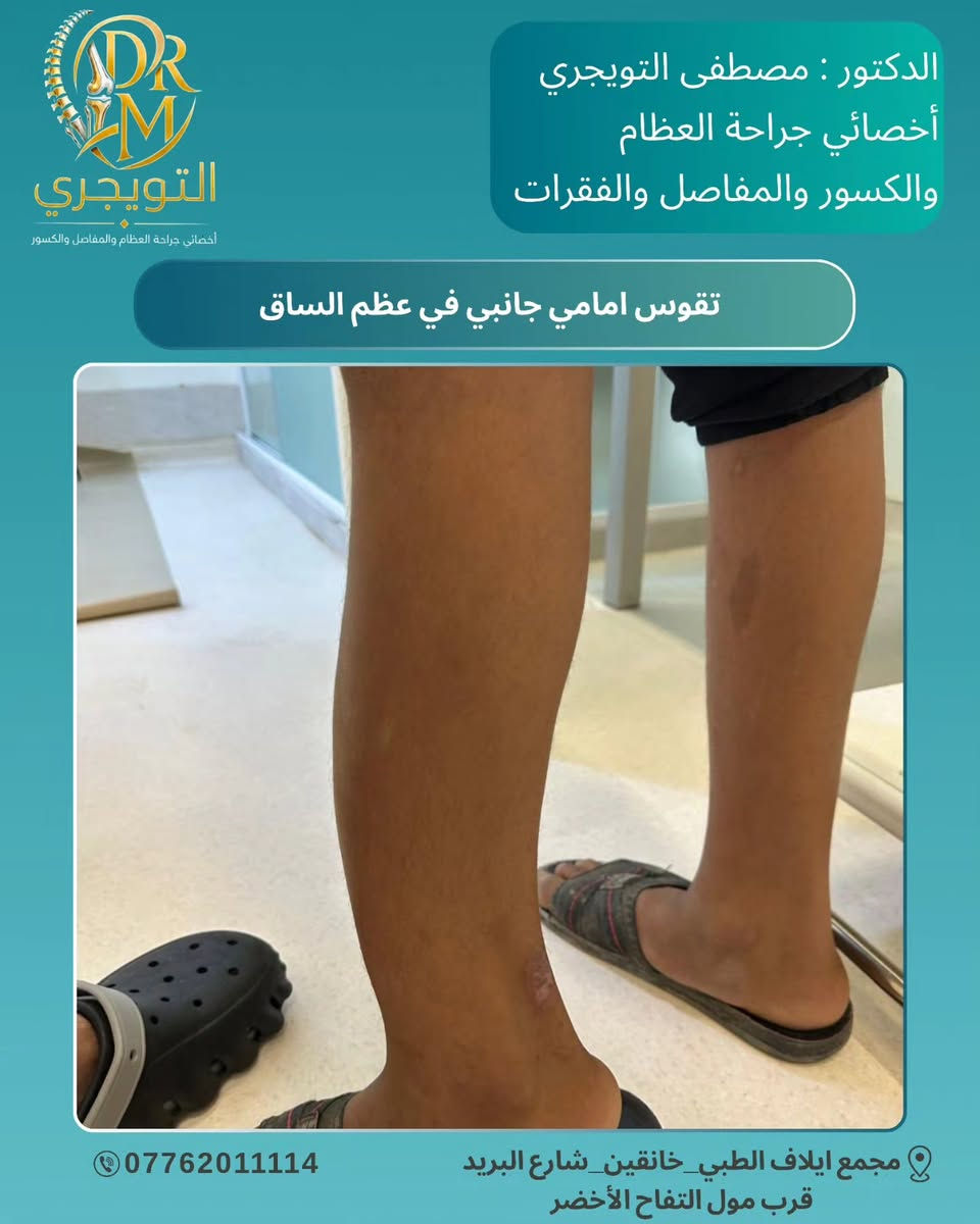🧬✨ مو كل علامة على الجلد تكون بسيطة… 

الورم الليفي العصبي من النوع الأول (Neurofibromatosis ) هو مرض وراثي يمكن أن يؤثر بشكل رئيسي على الجلد الأعصاب العظام والعينين 🧠🦴👁️ 

التشخيص المبكر والمتابعة الطبية يساعدان على اكتشاف التغيرات ومتابعتها بشكل أفضل ❤️‍🩹 

🔎 الوعي بالمرض… أول خطوة نحو رعاية أفضل.
الدكتور : مصطفى التويجري
أخصائي جراحة العظام والكسور والمفاصل 👨‍⚕️ 

📞 للحجز والاستفسار تواصل معنا الآن
📞 *********** 

📍 العنوان: مجمع إيلاف الطبي _ ديالى خانقين _ شارع البريد _ قرب مول التفاح الأخضر 

✨ رعايتك تبدأ بخطوة… وخطوتك الأولى هي الاستشارة الصحيحة. 

#الدكتور_مصطفى_التويجري
#مجمع_إيلاف_الطبي #خانقين
#الورم_الليفي_العصبي 
#Neurofibromatosis
