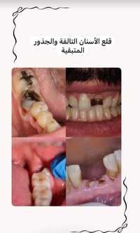 علاج أسنان مجاني • حشوات ضوئية • قلع أسنان وجذور
