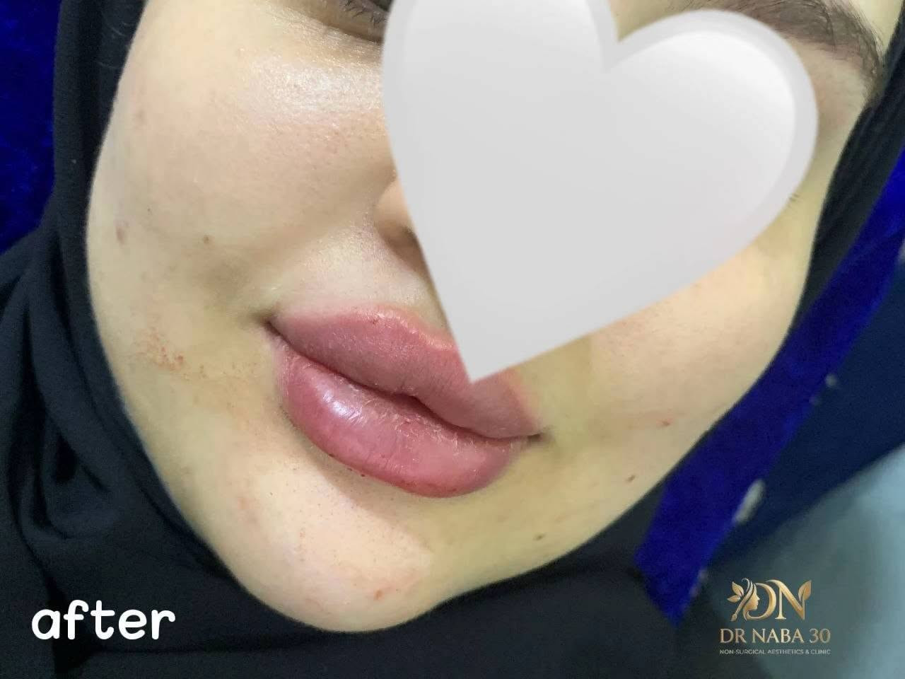 هلاوو بنات حبيت انقللكم تجربتي ويه الحقن طبعا اني كلش خوافة بس التجربة تموت وتستحق
حقن فلر شفة وتصبغات والنتيجة تخبل 
واختي سوت بوتوكس 
تعامل المركز يخبل والدكتوره حيل حبابه 

اي استفسار سالوني هنا او ع خاص
تعديل/ الي رادو المركز هاي صفحتهم وعدهم عروض

العنوان

 /تقاطع الجدوع مجاور عالم الحليب 

https://www.instagram.com/alhuda.dental.rafai?stkn=MWtkMWM0YmdyNm1ndQ==

***********

نص مكتوب في الصور:
- after DN DR NABA 30 NON-SURGICAL AESTHETICS & CLINIC