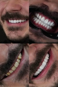تبييض أسنان • حشوات تجميلية • اربيل ناز ناز