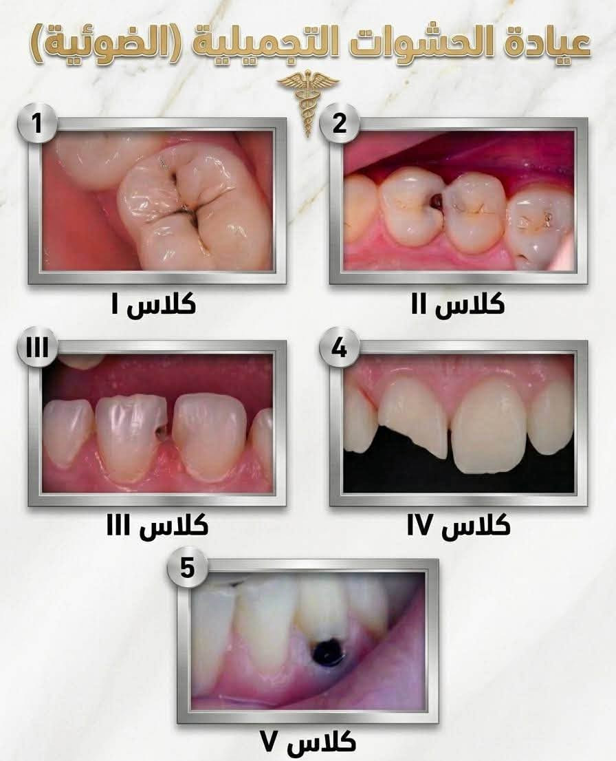 جامعة البيان • علاج مجاني • حشوات ضوئية