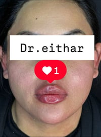 كونتور الوجه • فيلر فك وذقن • د. ايثار