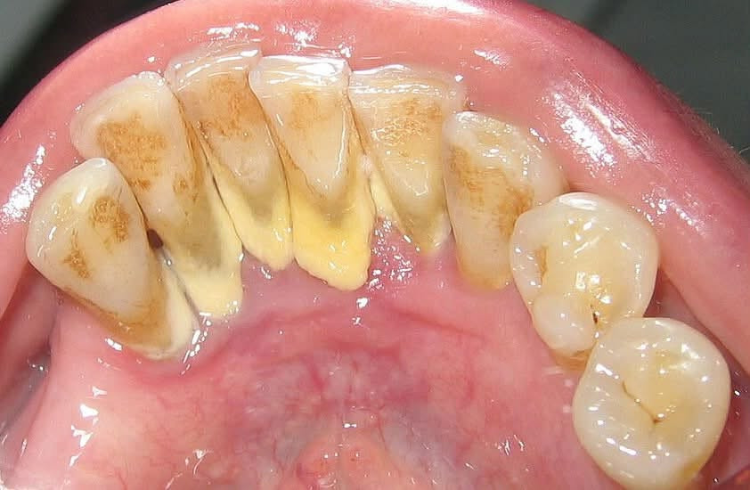 السلام عليكم 
اي احد يحتاج حشوة اسنان تجميلية
قلع اسنان او جذور متبقية، تنظيف اسنان، طقم اسنان متحرك جزئي او كامل
يراسلني على هذا الرقم
***********
العلاج في جامعة التراث تحت إشراف اطباء اسنان اختصاص

نص مكتوب في الصور:
- before | قبل
- after | بعد