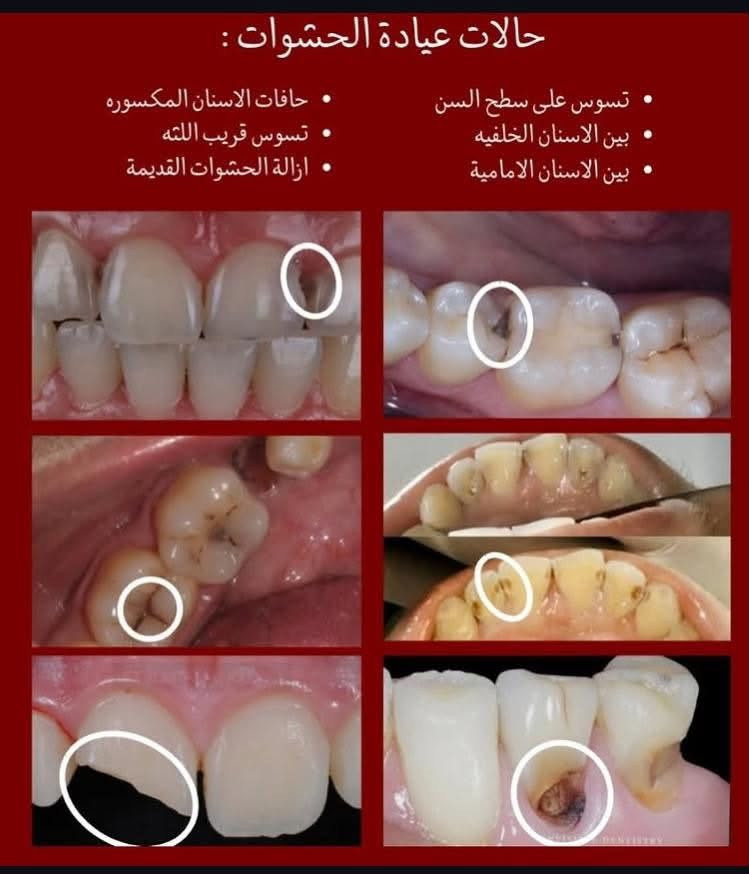 الى كل اهالي الدورة الاحباء حبينا نذكركم ما تهملون اسنانكم ! اهالينا كبار وصغار😍
صراحة الدكتورة ما اعرفها لكن على شغلها والدقة كلت ضروري اي شخص بالدورة او قريب من الدورة يعاني من اي مشكلة من المشاكل الموجودة تحت في الصور 
شغل نظيف ايد خفيفة والاهتمام بكل التفاصيل 
طبعا لليسألون الدكتورة تشتغل داخل عيادات جامعة دجلة لطب الاسنان مجانااا مجانااا 
اذا حابين تعرفون تفاصيل اكثر وايام الشغل تواصلوا مع الرقم واتساب رصيد موجود
***********

نص مكتوب في الصور:
- حالات عيادة التنظيف : التكلساات التصبغات بسبب التدخين والمشروبات اي احد يحب يسوي تنظيف يكدر يتواصل ويايه ( اللي موضح بلصوره كذلك )
- حالات عيادة الجراحة : بقايا جذور الاسنان التالفه الاسنان المتحركه الاسنان التالفه
- 5
- حالات عيادة التعويض :
- تعويض الاسنان المفقوده بطقم جزئي متحرك مثل الحالات الموضحه بلصور
- ovable Upper & Lower Partial Dentur
- BEFORE
- AFTER
- efore
- 600 x 38
- حالات عيادة الحشوات : حافات الاسنان المكسوره تسوس قريب اللثه ازالة الحشوات القديمة تسوس على سطح السن بين الاسنان الخلفيه بين الاسنان الامامية