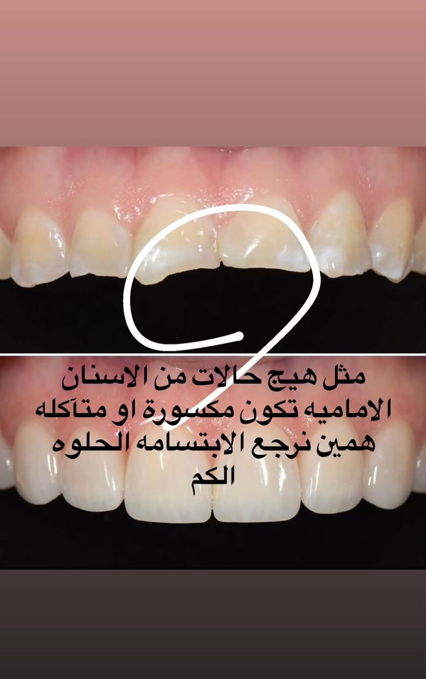 � رجعت العيادات، وراح أرجع أستلم حجوزات!
إذا عندك/ج سن مأجل علاجه من زمان.. يمكن هسه وقته! 🦷🤍

🚨 جبتلكم خبر حلو هم!
صرت أستلم أطفال وأعتني بأسنانهم 👧🏻🧒🏻🦷
إذا يحتاجون علاج للتسوس، ونقدر نسويلهم تطبيق فلورايد لحماية أسنانهم ✨

وكذلك أستلم حشوات جذور للأسنان الأمامية 🦷

📍 العنوان: جامعة التراث – المنصور
☎️:***********
Inst:dr__.manar

الحالات تشمل:
🦷 الحشوات
🦷 حشوات الجذور
🦷 القلع
🦷 تنظيف الأسنان
🦷 تركيب طقم كامل للأسنان المفقودة

🤍 علماً أن العلاج مجاناً وتحت إشراف الأطباء الاختصاص.

وسيتم تنزيل الحالات المطلوبة، فإذا حابين تكون حالتكم من ضمن الحالات، راسلوني حتى يتم تثبيت الموعد 🌷

وأتشرف جداً أكون أنا اللي أتابع حالاتكم 🤍🫶�

نص مكتوب في الصور:
- الي عدهم هيج جذور متبقية راسلوني
- الي عدهم هيج حالات يحتاجون تنظيف
- و الي هيج شمنتظرين ؟ تعالوا تنظيف مجاني FREE
- مثل هيج حالات من الاسنان الاماميه تكون مكسورة او متآكله همين نرجع الابتسامه الحلوه الكم
- لو هيج حالات من التسوس يكون قريب من اللثه