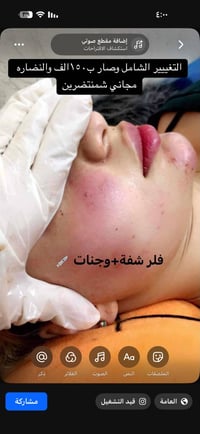توتة نعمان نذير • تغيير شامل • فلر شفة وجنات