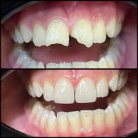 علاج مجاني • علاج تسوس • كلية طب الاسنان