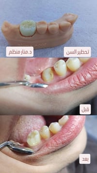 زركون • ابتسامة طبيعية • حي الإعلام