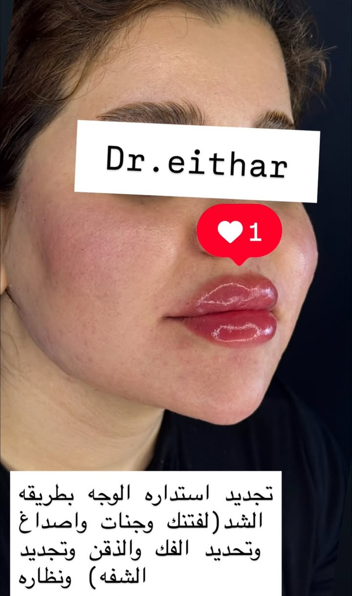 تجديد استداره الوجه كامله (لفتنك وجنات واصداغ وتدوير الفك والذقن والشفه ونظاره)
الصور قبل الحقن الاول قبل سنتين تقريبا وصار تجديد  هاي ثالث مره🔥🔥

عروووض فرحة الزهره ثبتتهه الكم بالستوري بالهايلايت وببوست اعلى الصفحة ✨✨

د.ايثار سامي عبد الامير
واسط الكوت الهوره مجمع القبطان طابق اول 

الحجز***********
