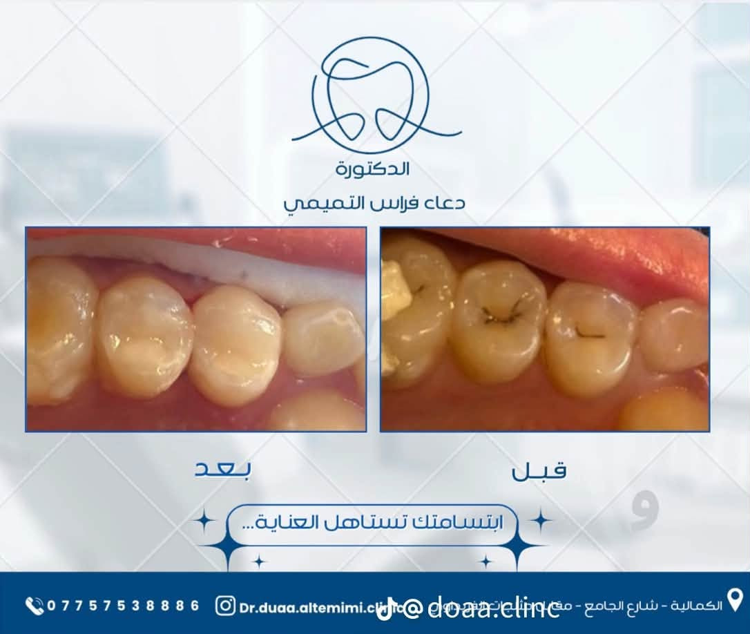 🦷عيادة الدكتورة دعاء فراس التميمي 🦷
-لعلاج الاسنان بالتقويم الشفاف والمعدني 

-زراعة الاسنان وعمل التراكيب السنية بالزاركون والسيراميك 

-عمل الحشوات التجميلية وحشوات الجذور 

-تنظيف وتبيض الاسنان بالليزر 

📍الكمالية - شارع الجامع  - مقابيل مثلجات الفريداوي 

🕠اوقات الدوام من الساعة 

4  مساءً الى الساعة  2 بعد منتصف الليل 

جميع ايام الاسبوع 

📞للحجز والاستفسار :

***********
