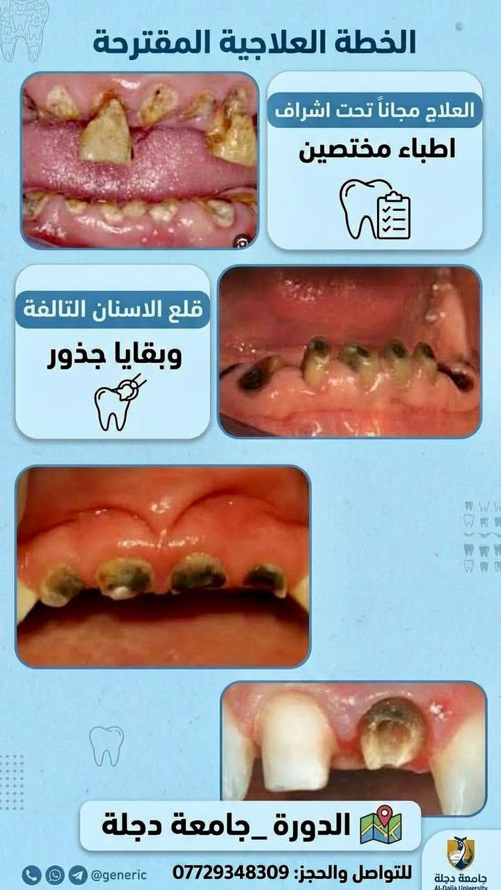 🦷 ابتسامتك وصحة أسنان عائلتك بأيدٍ أمينة… ومجاناً بالكامل ...

تحت إشراف نخبة من الأطباء والأخصائيين، يعلن فريق  طبي متخصص  من الكوادر النسائية في جامعة دجلة عن استقبال الحالات المرضية لتوفير الفحص والعلاج مجاناً بالكامل (100%) دون تحمل أي أجور للكشفية أو المواد أو العمل العلاجي.

✨ علاج مجاني بالكامل | أجهزة حديثة | إشراف طبي متخصص | عناية وتعقيم بأعلى المستويات

ويتم تقديم العلاج تحت إشراف مباشر من طبيبات أخصائيات، حرصاً على الدقة وجودة العمل وسلامة المراجعين.

👧 عيادة الأطفال | من عمر 4 إلى 11 سنة

تشمل الخدمات:
• علاج تسوس الأسنان وحشوات الأسنان اللبنية.
• قلع الأسنان التالفة أو المتحركة بعناية وحرص.
• تنظيف الأسنان.
• سد الفجوات للمساعدة في حماية أسنان الطفل من التسوس.

👩 عيادة النساء | جميع الأعمار

تشمل الخدمات:
• الحشوات التجميلية والحشوات الاعتيادية.
• تنظيف الأسنان وإزالة التكلسات والتصبغات.
• تعويض الأسنان المفقودة من خلال أطقم الأسنان والجسور.

👴 عيادة كبار السن | من عمر 60 سنة فما فوق

• صناعة وتعويض أطقم الأسنان الكاملة والجزئية للفك العلوي والسفلي.
• المساعدة على استعادة القدرة على المضغ وتحسين وظيفة وشكل الأسنان.

📍 الموقع:
بغداد – الدورة – شارع المصافي – جامعة دجلة الأهلية

💰 التكلفة:
مجــانــاً 100%
دون أي رسوم للكشفية أو المواد أو العمل العلاجي.

🩺 خصوصيتك وسلامتك أولويتنا
كادر طبي نسائي، مع الالتزام بأعلى معايير التعقيم والعناية أثناء تقديم الخدمات العلاجية.

📩 للحجز والاستفسار:
يرجى إرسال رسالة خاصة لغرض الفرز وتحديد الأولوية، أو التواصل عبر الواتساب:
📞  ***********

✨ لا تؤجل علاج أسنانك… ولا تحرم طفلك من ابتسامة صحية.
احجز الآن واستفد من العلاج المجاني بالكامل في العيادات التعليمية بجامعة دجلة الأهلية.

نص مكتوب في الصور:
- عناية بابتسامات أطفالنا
- صحة أسنان طفلك، أمان وثقة.
- وكل مشاكل اسنان الاطفال 💙
- بغداد/الدورة/ شارع المصافي/جامعه دجلة 📍
- للحجز والاستفسار: 📷 📞 ***********
- جامعة دجلة Digla University Dental Clinic مركز طب الأسنان التابع لجامعة دجلة - خدمات علاجية شاملة تسوس الأضراس الخلفية كسر في الأسنان الأمامية تراجع اللثة وتآكل الأسنان كسر في السن السفلي • العلاج المجاني تحت إشراف أخصائيين برعاية كلية طب الأسنان - جامعة دجلة • الموقع حي الدورة, بغداد, العراق - مبنى جامعة دجلة www.diglauniversity info@digladeals.com 024-973727
- عيادة تنظيف الاسنان
- ازالة التكلسات والتصبغات
- العلاج مجانًا تحت إشراف اطباء مختصين
- الموقع: الدورة _جامعة دجلة
- طقم الأسنان المتحرك
- حل احترافي لتعويض الأسنان
- تعويض الأسنان المفقودة من خلال طقم الأسنان المتحرك
- حلول عملية ومريحة لاستعادة ابتسامتك
- العنوان: بغداد - الدورة - شارع المصافي
- عيادة جامعة دجلة
- للحجز: + ***********
- الخطة العلاجية المقترحة العلاج مجاناً تحت اشراف اطباء مختصين قلع الاسنان التالفة وبقايا جذور الدورة_جامعة دجلة للتواصل والحجز: *********** @generic جامعة دجلة Al-Dajla University