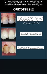 علاج أسنان مجاني • حشوة جذر • جامعة البيان
