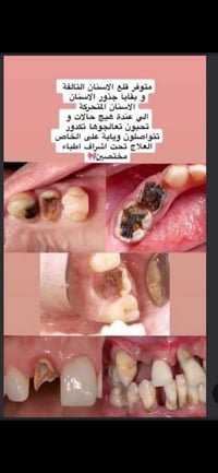 قلع مجاني • كلية طب الأسنان باب المعظم • بإشراف جامعة بغداد