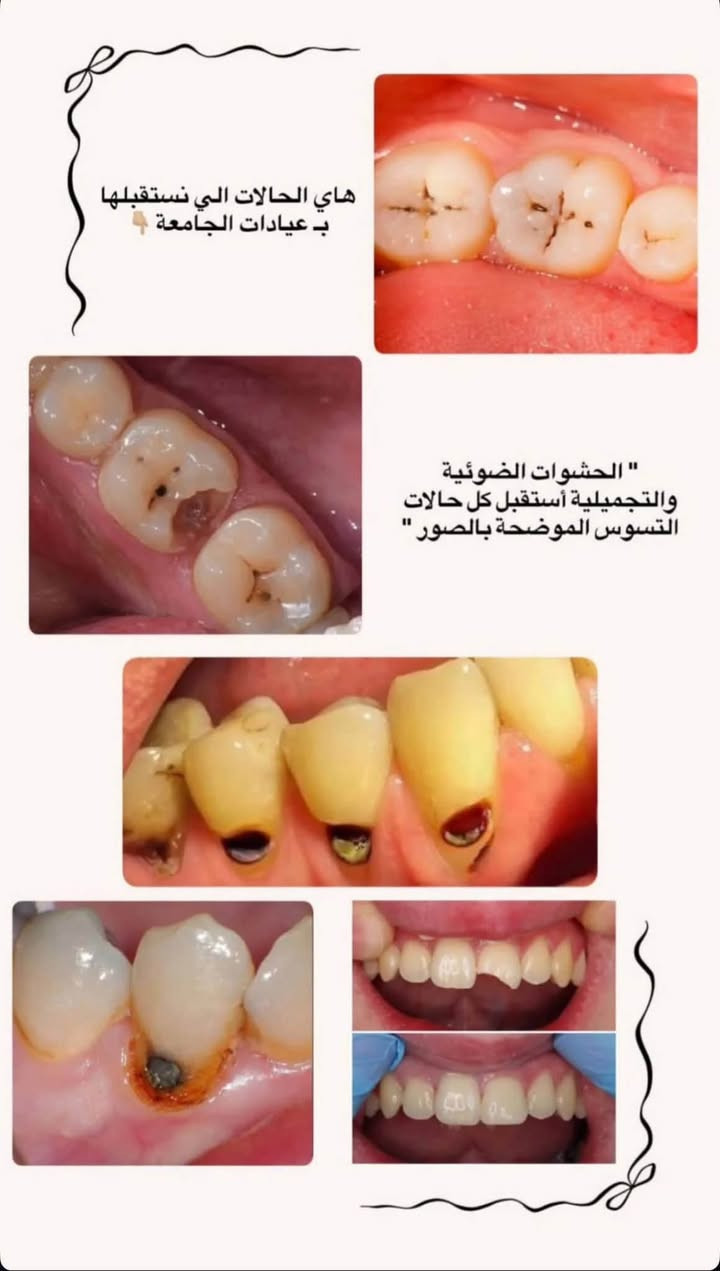 🔴 علاج مجاني 🦷 / (تحت اشراف اطباء مختصين)
الي يحب يتفضل واتساب: ***********
متوفر:  
قلع الاسنان والجذور التالفة والاسنان المكسورة  
حشوات تجميليه ( للاسنان المتسوسه والمكسورة )  
تركيب الاسنان (الطقم الجزئي لتعويض الاسنان)  
العنوان: الجامعة الوطنية للعلوم والتكنولوجيا

نص مكتوب في الصور:
- قلع الأسنان التالفة وسن العقل والجذور المتبقية
- هاي الحالات الي نستقبلها ب عيادات الجامعة " الحشوات الضوئية والتجميلية أستقبل كل حالات التسوس الموضحة بالصور "
- أزالة التكلسات والترسبات وتنظيف الاسنان Dr Lobna K.