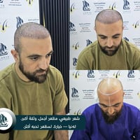 زراعة شعر • لەنیا • كلار