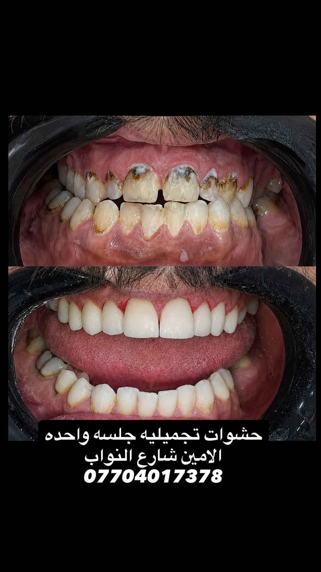 حشوات تجميلية • جلسة واحدة • الامين شارع النواب