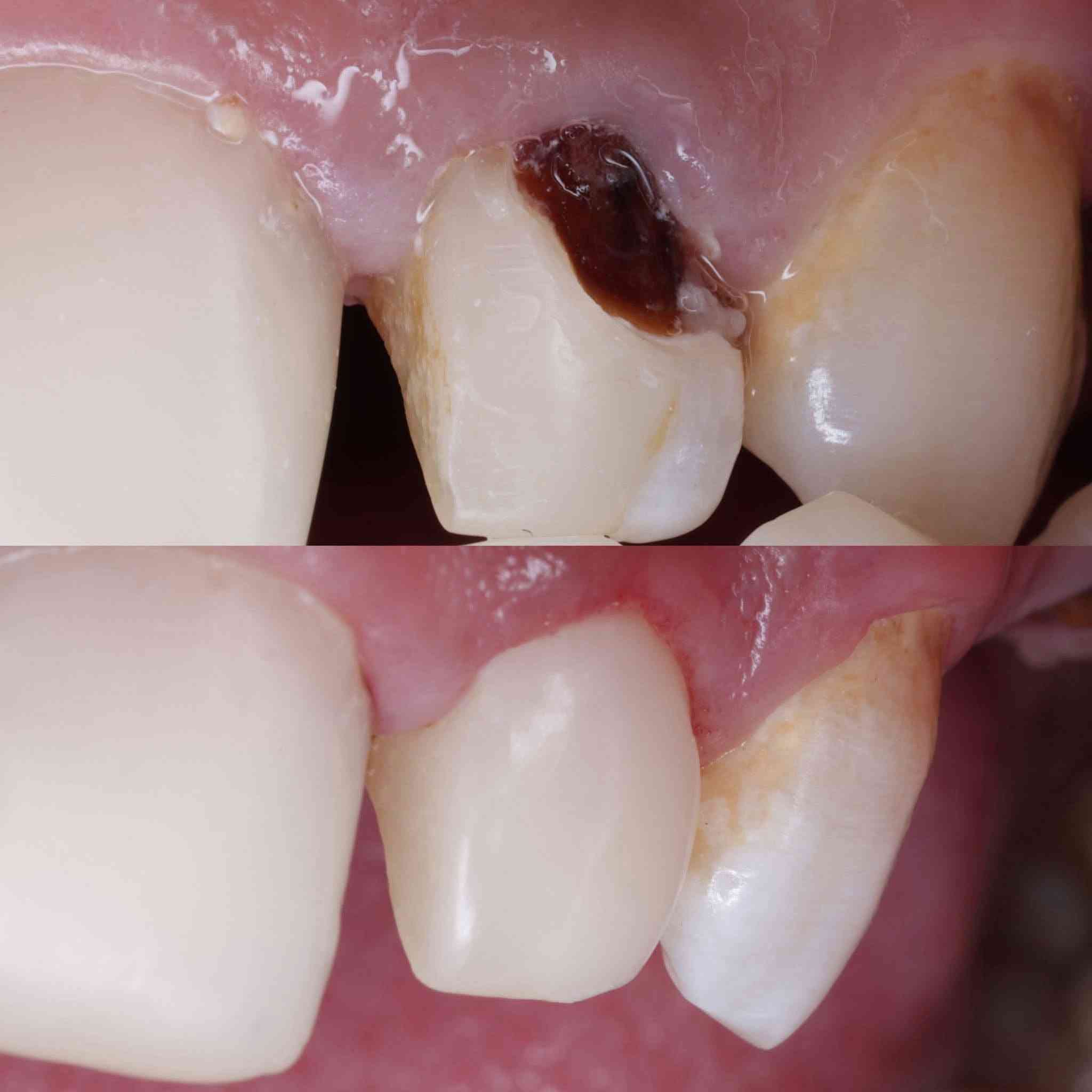 🦷 علاج أسنان مجاني بالكامل
تعلن جامعة ابن سينا للعلوم الطبية والصيدلانية – كلية طب الأسنان عن استقبال المرضى لتقديم عدد من الخدمات والعلاجات السنية مجاناً بالكامل، وذلك بإشراف أطباء اختصاص وكادر طبي متخصص.
📅 موعد بدء استقبال المرضى: 22/9
الخدمات المتوفرة:
• تعويض الأسنان المفقودة بطقم متحرك (كامل أو جزئي)
• الحشوات الضوئية
• قلع الأسنان وبقايا الجذور
• تنظيف الأسنان وإزالة التكلسات والتصبغات
📍 الموقع:
جامعة ابن سينا للعلوم الطبية والصيدلانية – بغداد / القادسية
مقابل محطة وقود البياع، بالقرب من جامعة الفراهيدي.
💙 جميع الخدمات المذكورة مجانية بالكامل، وتُقدَّم بإشراف أطباء اختصاص وكادر طبي.
📞 للاستفسار والحجز:
***********
📱 متوفر واتساب وتليكرام

نص مكتوب في الصور:
- قبل
- بعد