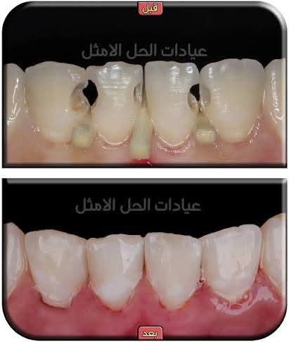 علاج مجاني • قلع أسنان • الكرادة