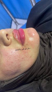 ✨ عرضنا غير هالمرة! ✨ جلسة نضارة + فيلر شفايف 💋✨ بس بـ 110 ألف فقط! 🔥 ...